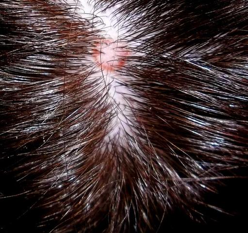 Was Ist Das Fur Ein Komischer Fleck Auf Meiner Kopfhaut Gesundheit Medizin Flecken