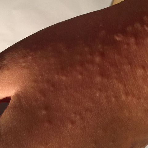 Allergie teppich Allergie teppich