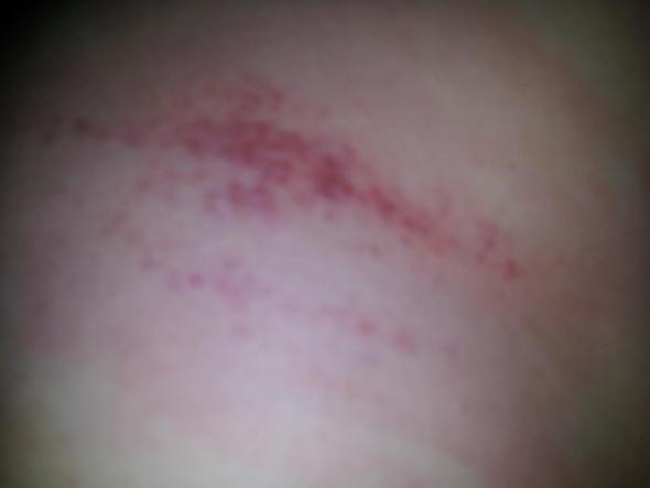 Komischer Hautausschlag O O Krankheit Haut Juckreiz Komischer Hautausschlag O O Krankheit Haut Juckreiz