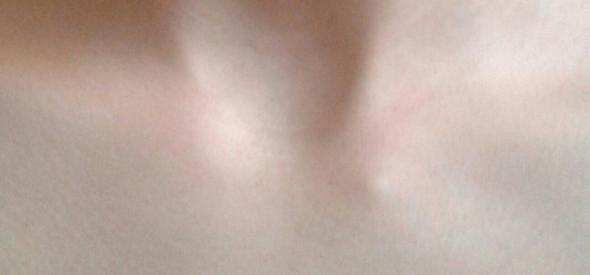 Komischer Hugel Unter Schlusselbein Arzt Knochen Komischer Hugel Unter Schlusselbein Arzt Knochen