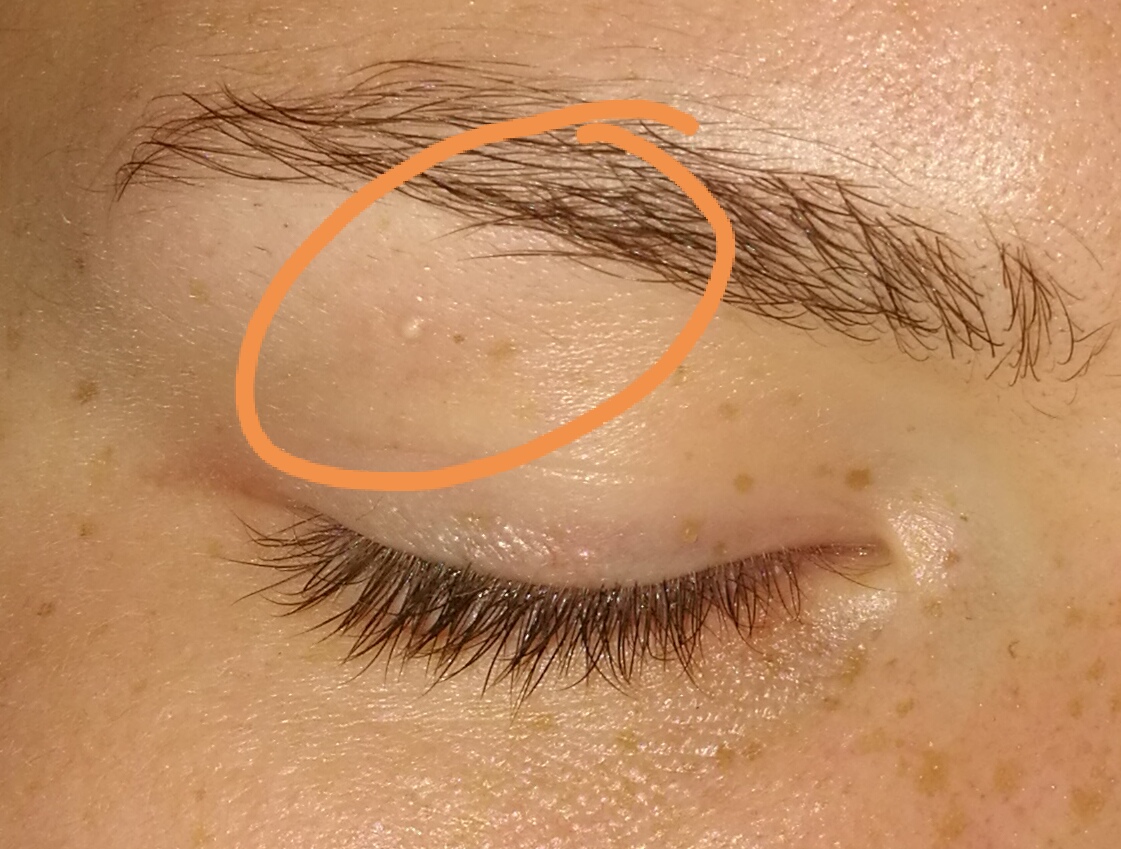 Komischer Kleiner Pickel Auf Dem Lid Gesundheit Und Medizin Haut Augen Komischer Kleiner Pickel Auf Dem Lid Gesundheit Und Medizin Haut Augen