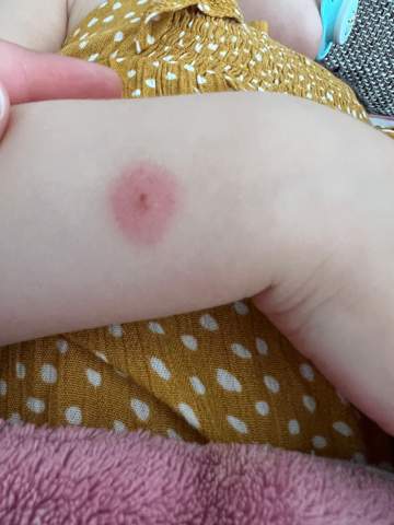 Komischer Mückenstich Kleinkind (2 Jahre)?