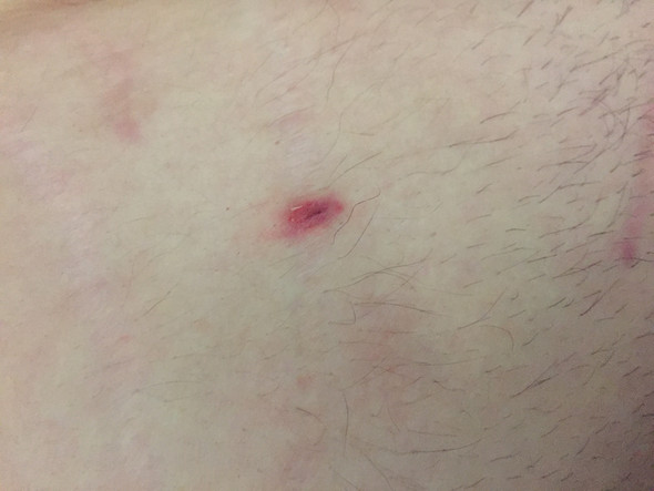 Sollte Ich Mit Diesem Pickel Am Bauch Zum Arzt Gesundheit Und Medizin Krankheit Hautarzt Sollte Ich Mit Diesem Pickel Am Bauch Zum Arzt Gesundheit Und Medizin Krankheit Hautarzt