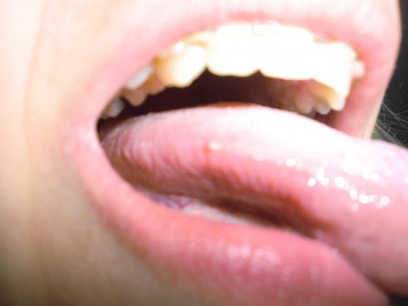 Zunge eiterbläschen Eiterpickel im