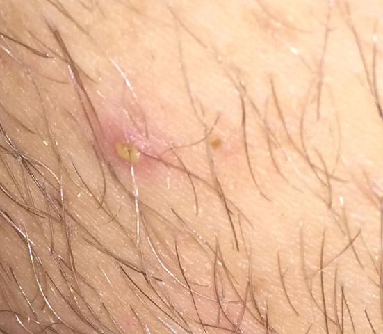 Komischer Pickel Im Intimbereich Was Ist Das Gesundheit Sex Haare Komischer Pickel Im Intimbereich Was Ist Das Gesundheit Sex Haare