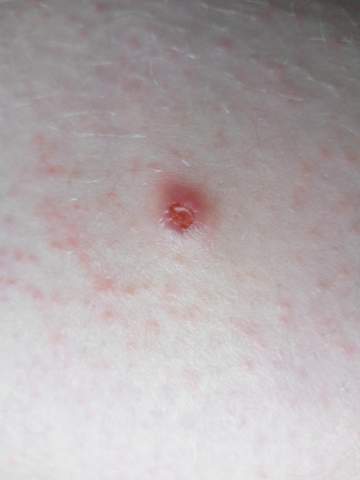 Komischer Pickel Mit Einem Loch Gesundheit Und Medizin Haut Komischer Pickel Mit Einem Loch Gesundheit Und Medizin Haut