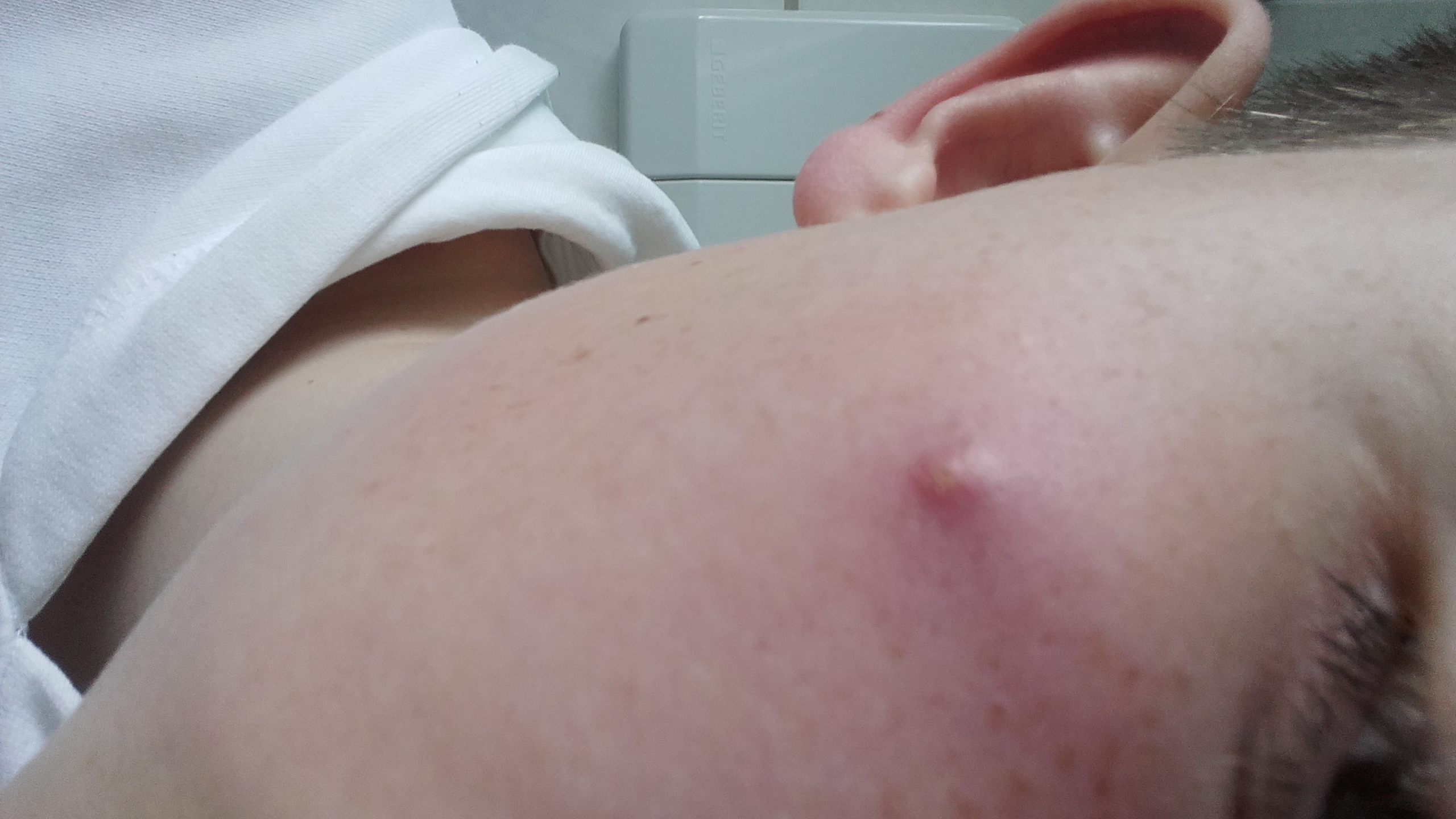 Komischer Riesen Pickel, schon seit min. Einem halben Jahr? (Gesundheit, Medizin, komisch) pickel hintern