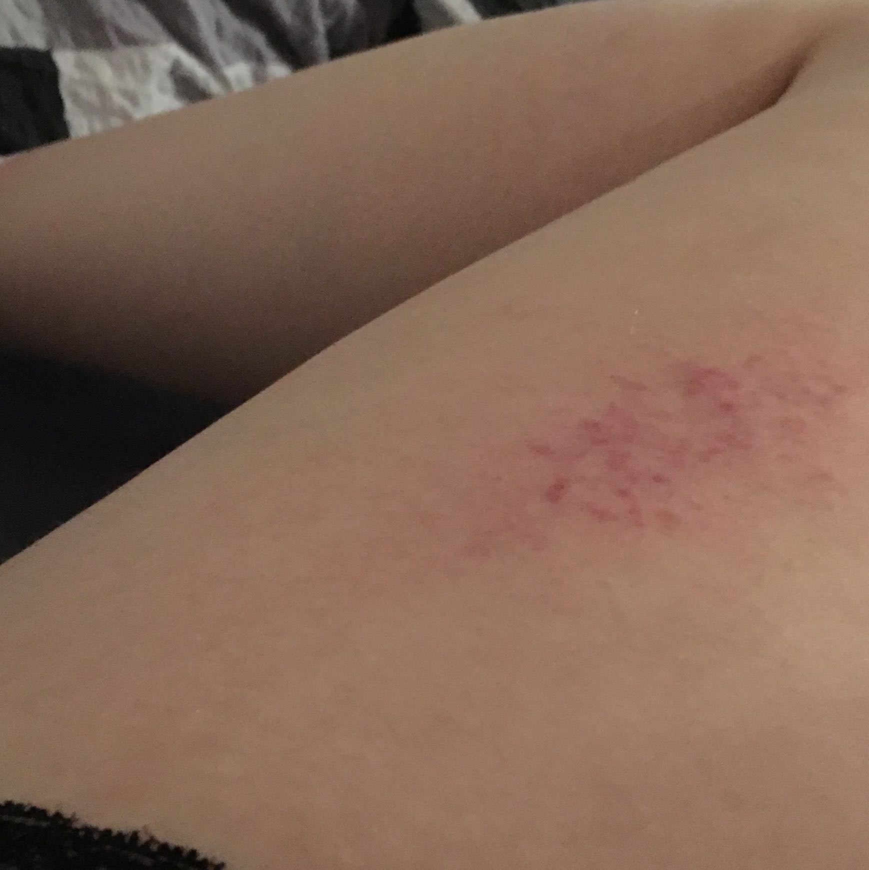 Komischer roter ausschlag beim Bein? (Gesundheit, Beine, jucken) Komischer roter ausschlag beim Bein? (Gesundheit, Beine, jucken)