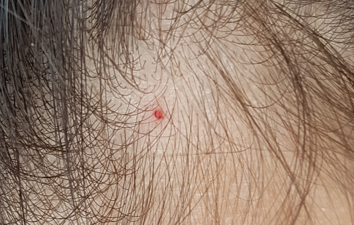 pickel auf der kopfhaut haarausfall pickel auf der kopfhaut haarausfall