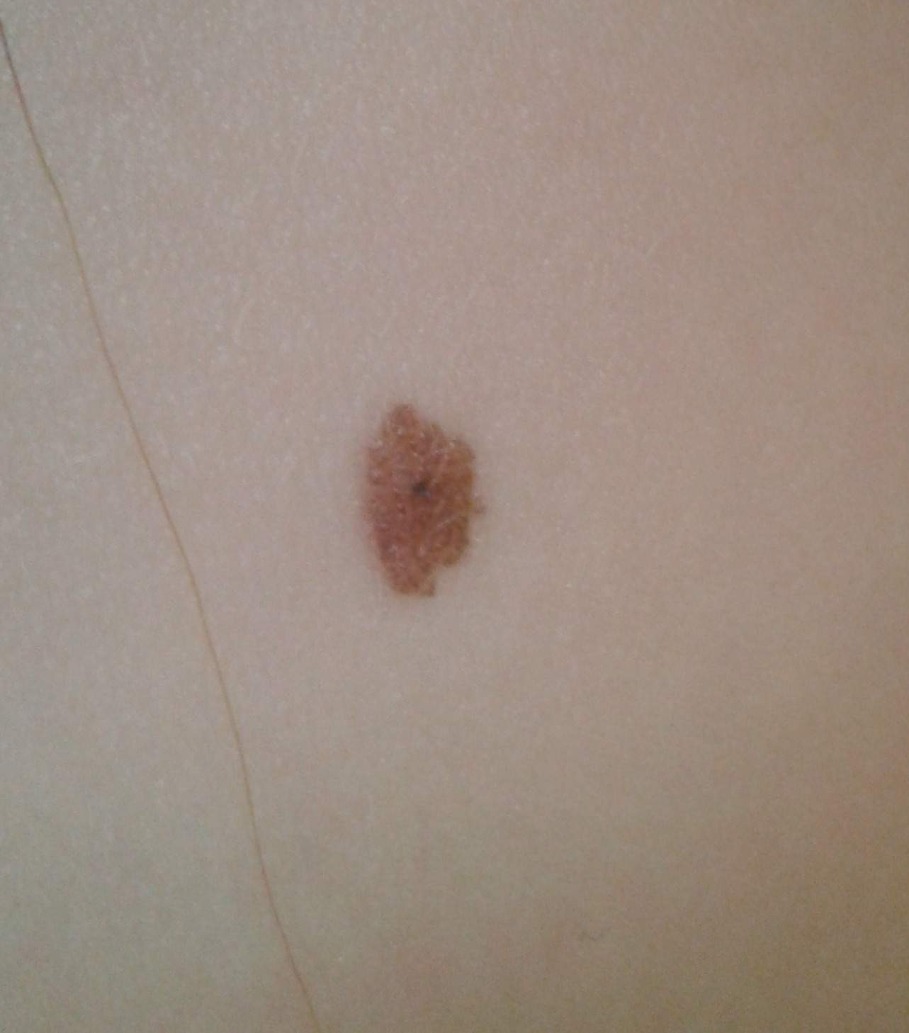 Komischer Schwarzer Punkt In Meinem Muttermal Hautkrebs Hautkrankheit Freizeit Komischer Schwarzer Punkt In Meinem Muttermal Hautkrebs Hautkrankheit Freizeit