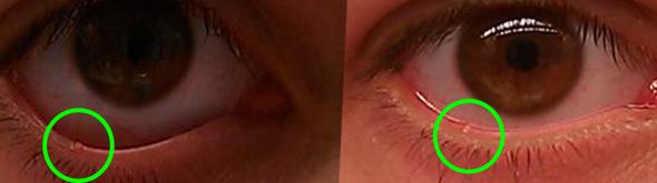 Komisches Ding Am Auge Help D Augen Pickel Infektion Komisches Ding Am Auge Help D Augen Pickel Infektion