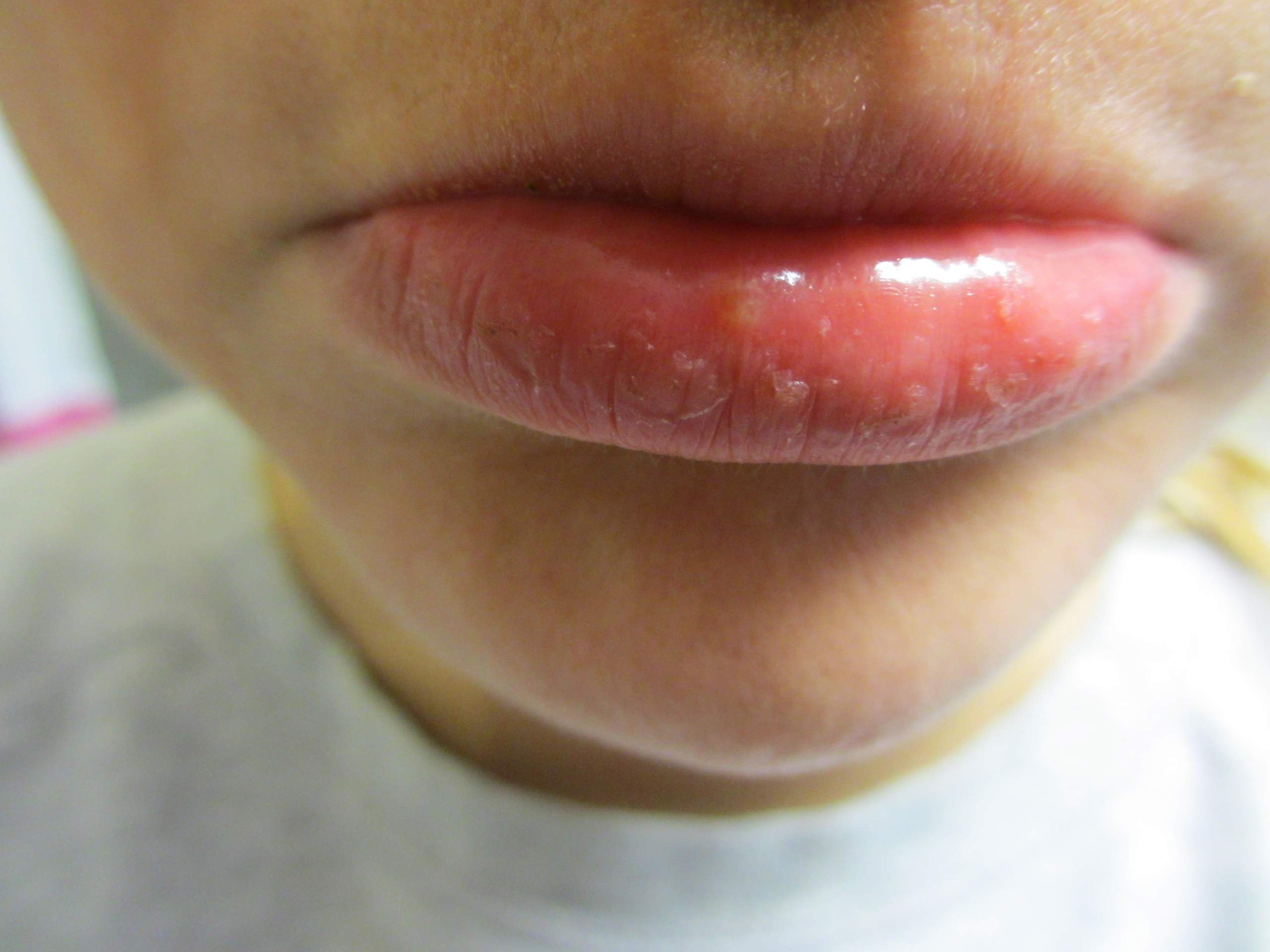 Komisches Ding IN der Unterlippe? (Gesundheit, Gesicht, Lippe)