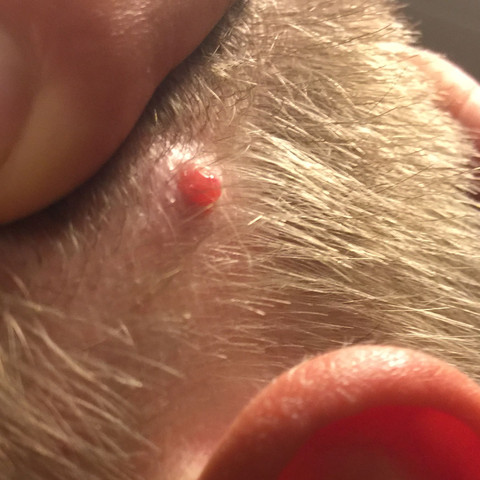 Bild 1 - (Medizin, Haut, Pickel)