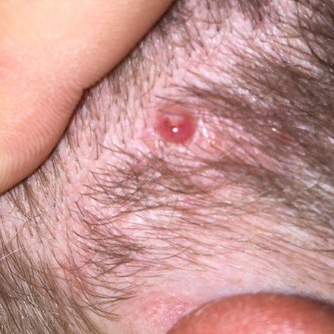 Bild 2 - (Medizin, Haut, Pickel)