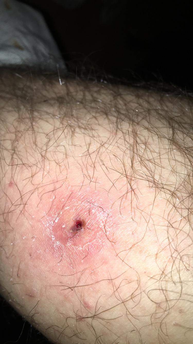 Komisches kleines Loch in der Waade? (Gesundheit, Arzt, Angst)