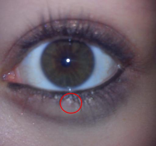 hm :/ - (Augen, Pickel)