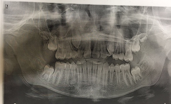 Kommt der Eckzahn wieder? (Gesundheit und Medizin)