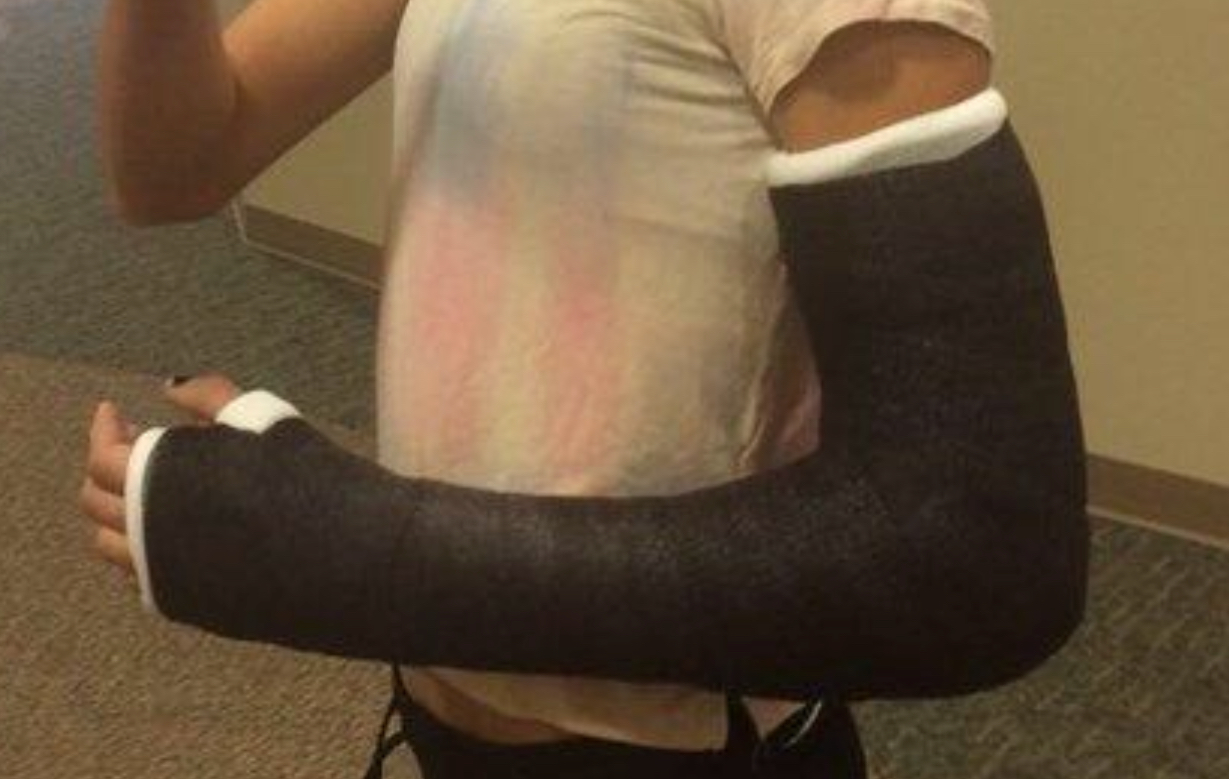 Kompletter Armbruch Gips Hatte Das Schon Mal Wer Gesundheit Und Medizin Schmerzen Krankenhaus Kompletter Armbruch Gips Hatte Das Schon Mal Wer Gesundheit Und Medizin Schmerzen Krankenhaus