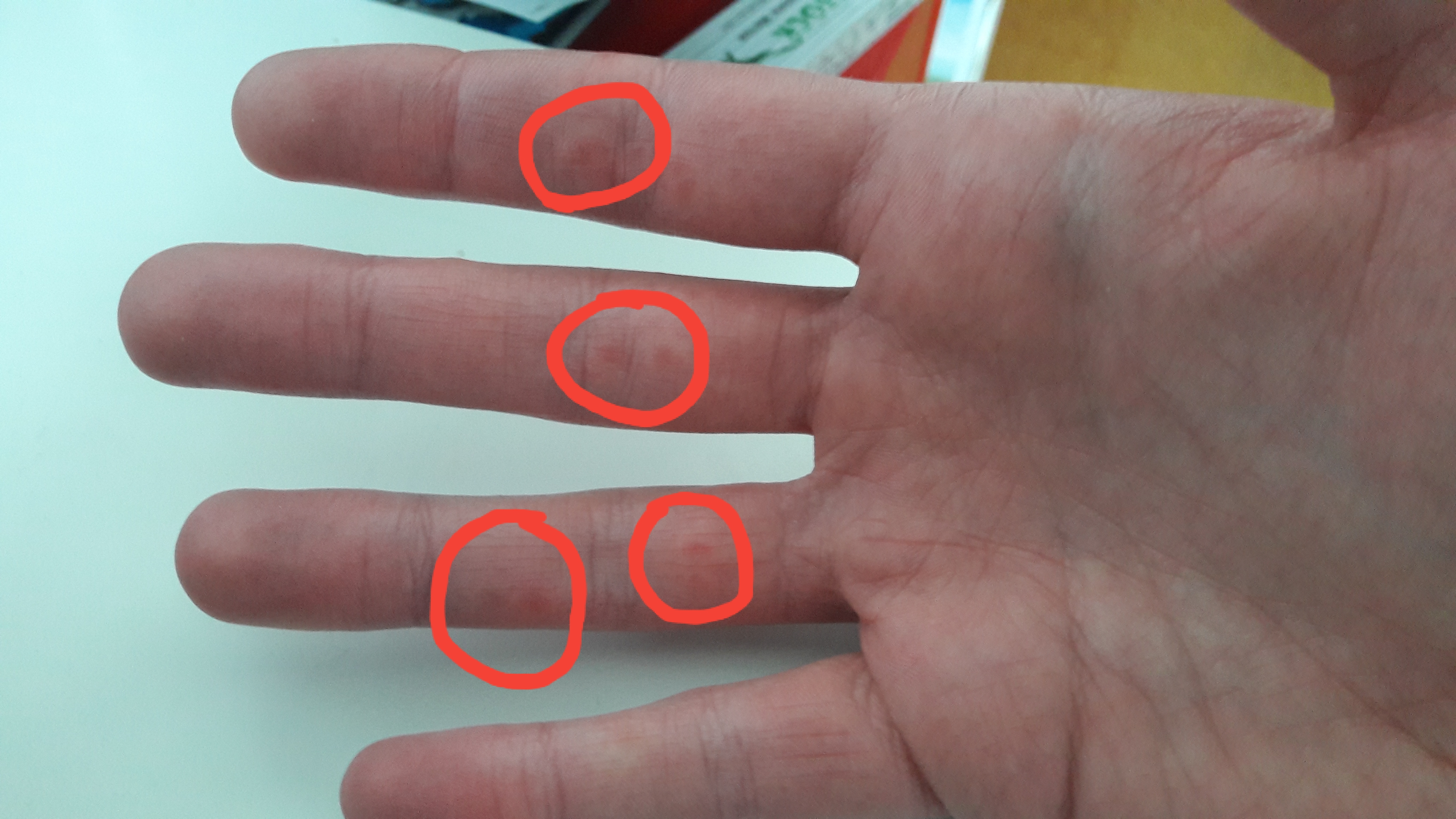 Kontaktallergie oder was? (Gesundheit, Gesundheit und Medizin, Allergie)