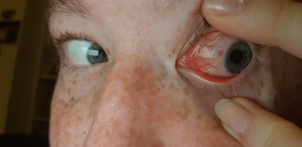 Kontaktlinse Klebt Am Auge Fest Was Soll Ich Tun Gesundheit Und Medizin Schmerzen Augen Kontaktlinse Klebt Am Auge Fest Was Soll Ich Tun Gesundheit Und Medizin Schmerzen Augen