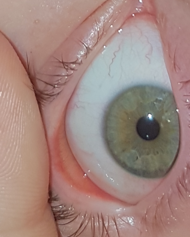 Kontaktlinse nicht zu finden im Auge?DRINGEND!? (Gesundheit und Medizin, Kontaktlinsen