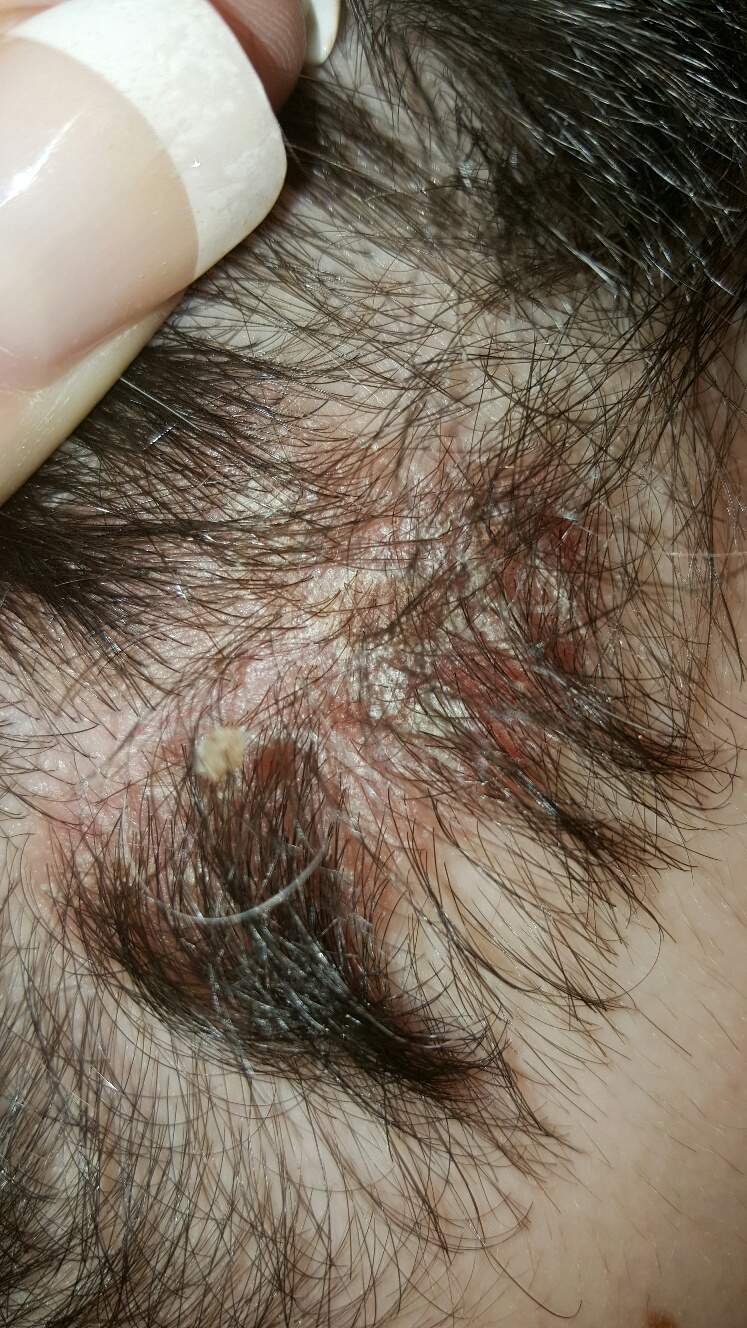 Kopfhaut Pilz Schuppen Bitte Dringend Hilfe Pilze Kopfhaut Pilz Schuppen Bitte Dringend Hilfe Pilze