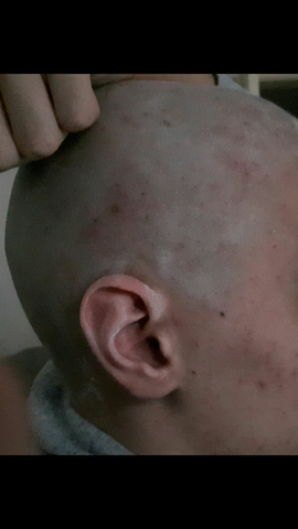 Mussen Die Wunden In Der Kopfhaut Vom Glatze Schneiden Behandelt Werden Wachsen Dort Dann Noch Haare