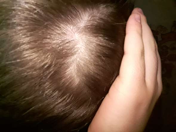 Kopfhaut Sichtbar Habe Ich Haarausfall Haare Hilflos 16 Jahre Alt