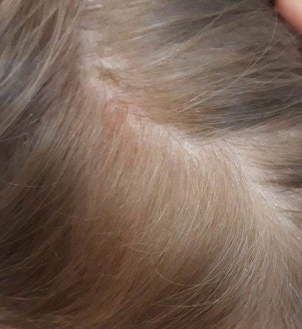 Kopfhautprobleme Kruste Gesundheit Und Medizin Schuppen Kopfhaut Kopfhautprobleme Kruste Gesundheit Und Medizin Schuppen Kopfhaut