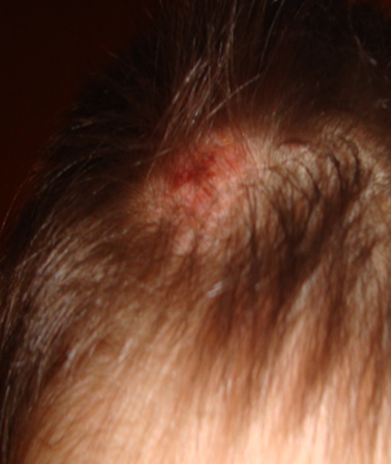 Kopfschorf Kopf Kopfschorf Kopf