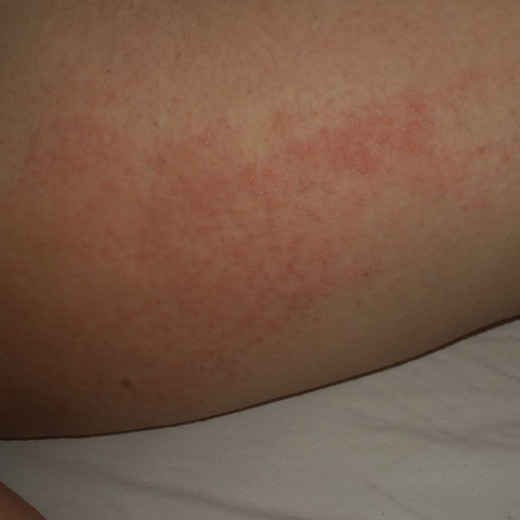 Krätze oder doch was anderes? (Gesundheit und Medizin, Allergie, Juckreiz) pickel an oberschenkel