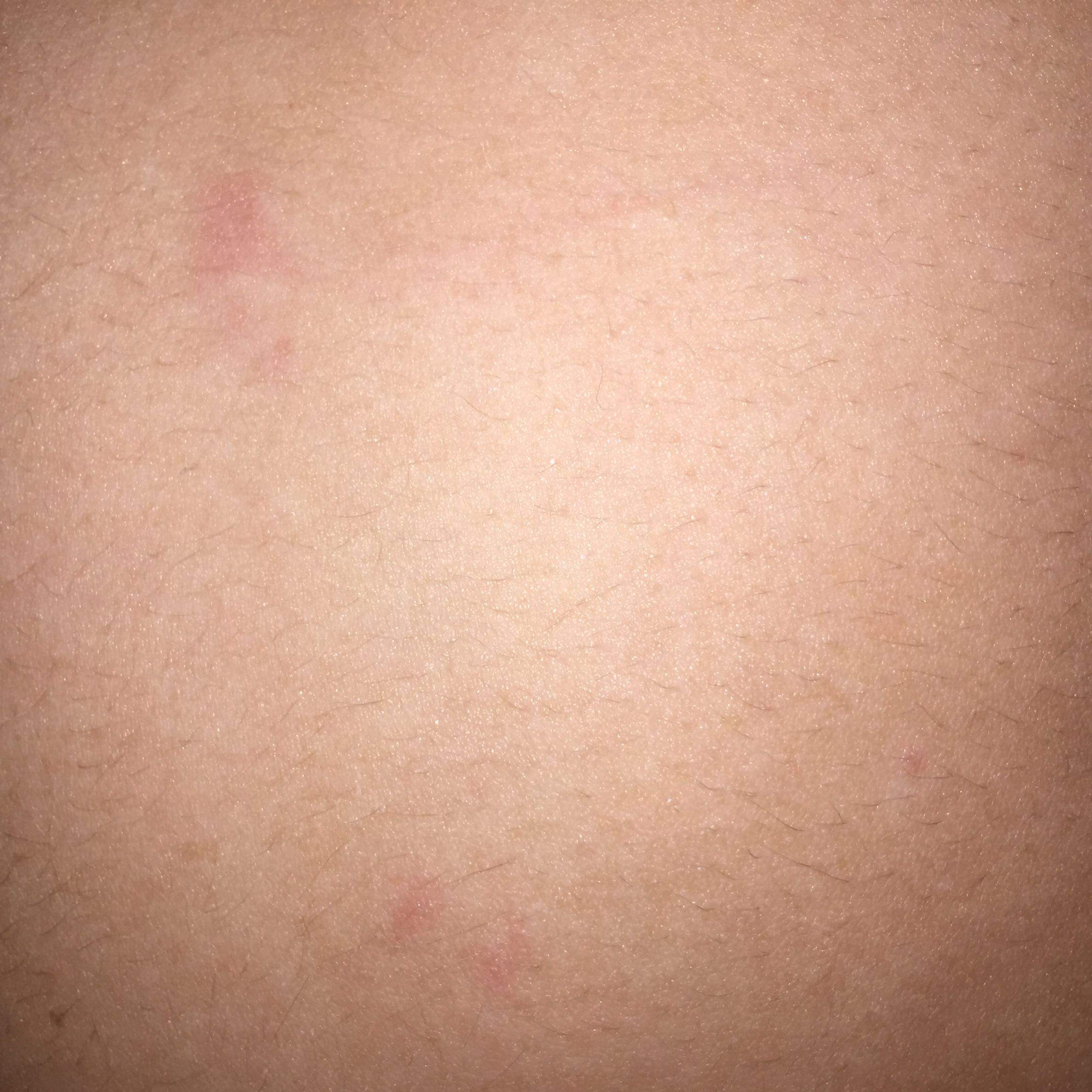 Krätze oder sonst was- Arzt? (Kindergarten, Ausschlag)