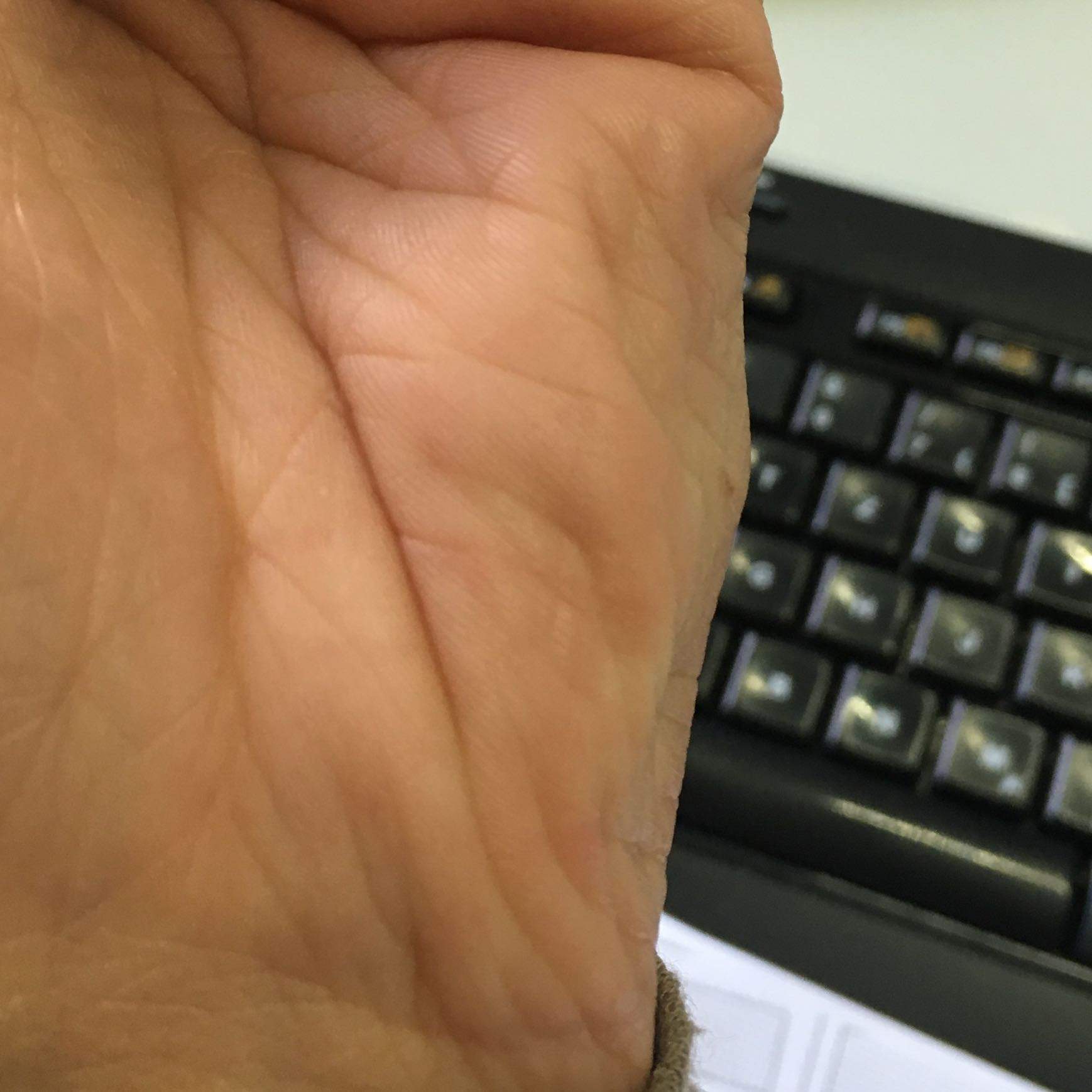 Krampf in der Hand-total komisch? (Gesundheit, Medizin, Körper)