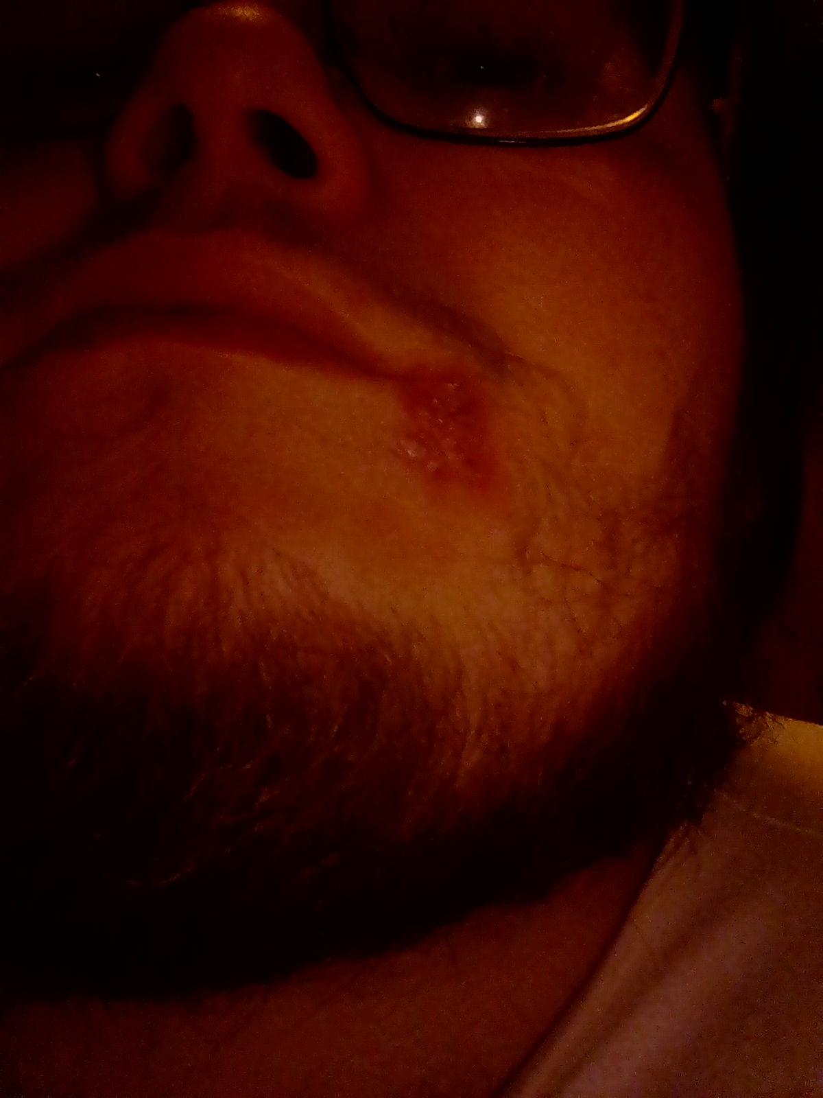 Krank Herpes Ansteckend Gesundheit