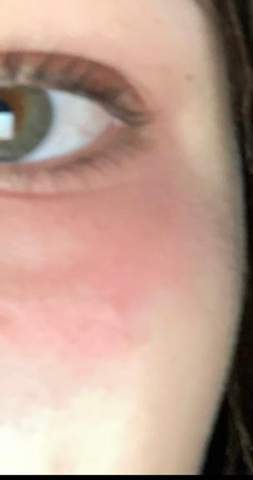 Krass Rote Haut Unter Den Augen Was Bedeutet Das Gesundheit Krass Rote Haut Unter Den Augen Was Bedeutet Das Gesundheit