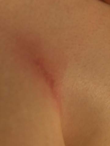 Kratzer Unter Der Brust Kratzer Unter Der Brust