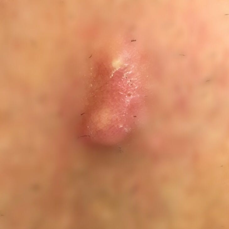 krebs angst was kann es sein arzt