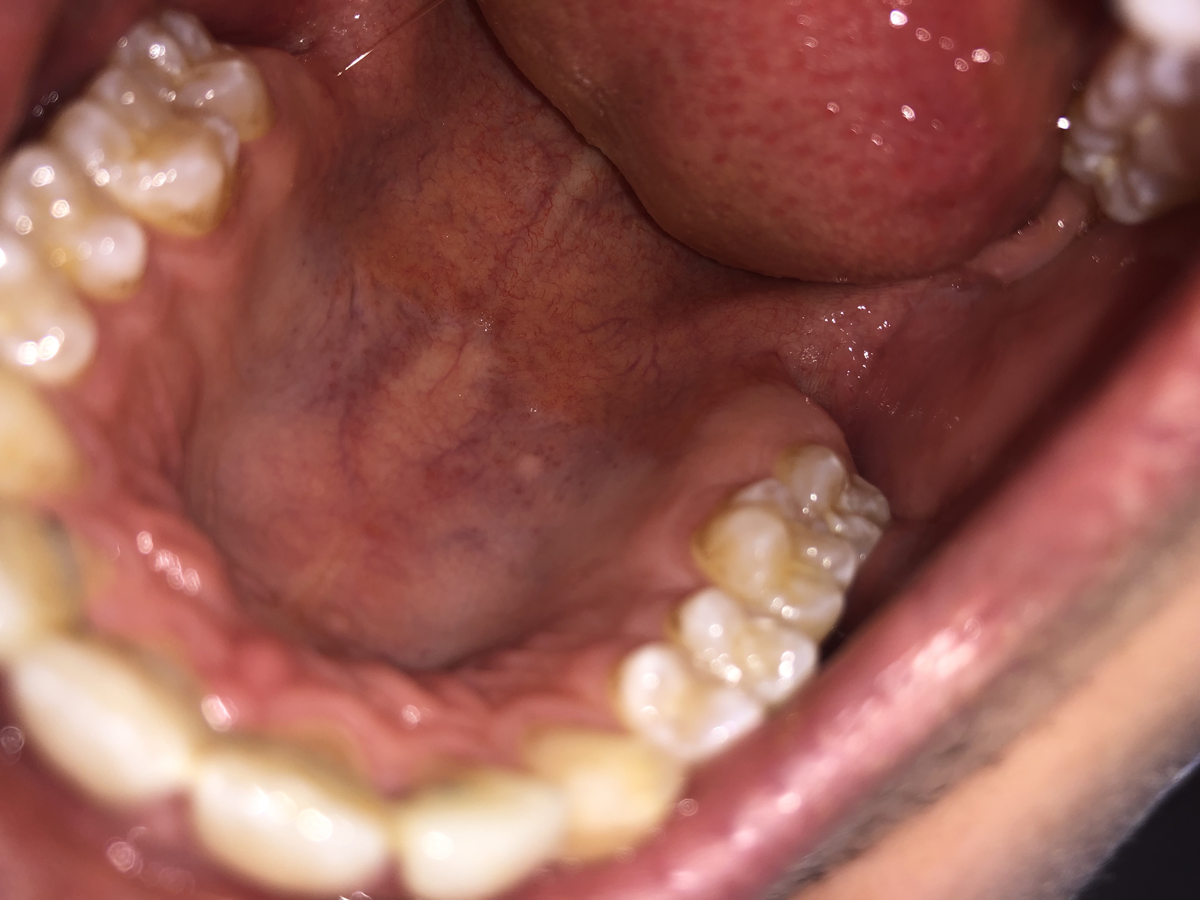 39++ Gutartiger tumor im mund bilder , Krebs im Mund? (Krankheit)