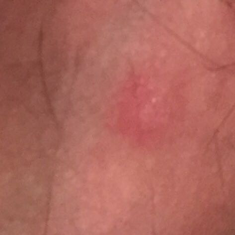 Krebs Unter Der Haut Oder Einfach Nur Eine Art Pickel Gefahrlich Spital