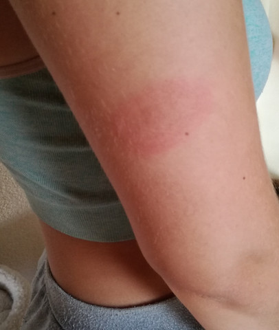 Kreis Um Den Schnakenstich Was Ist Das Gefahr Stich Kreis Um Den Schnakenstich Was Ist Das Gefahr Stich