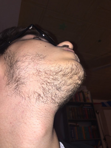 Kreisrunder Haarausfall Im Bart Gesundheit Und Medizin Gesundheit Haare Kreisrunder Haarausfall Im Bart Gesundheit Und Medizin Gesundheit Haare