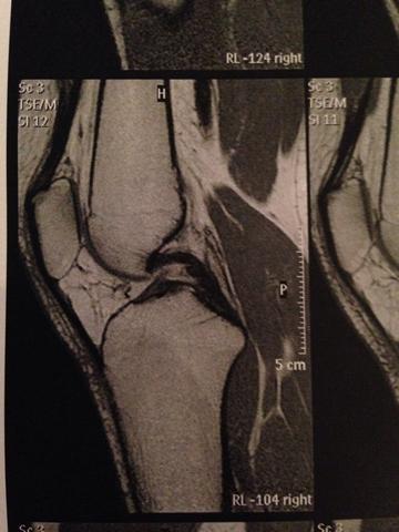 MRT Aufnahme rechtes Knie - (Verletzung, Kreuzbandriss)