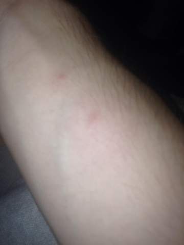 Kriebelmuckenstich Oder Normale Mucken Borielliose Gesundheit Und Medizin Gesundheit Insektenstich Kriebelmuckenstich Oder Normale Mucken Borielliose Gesundheit Und Medizin Gesundheit Insektenstich