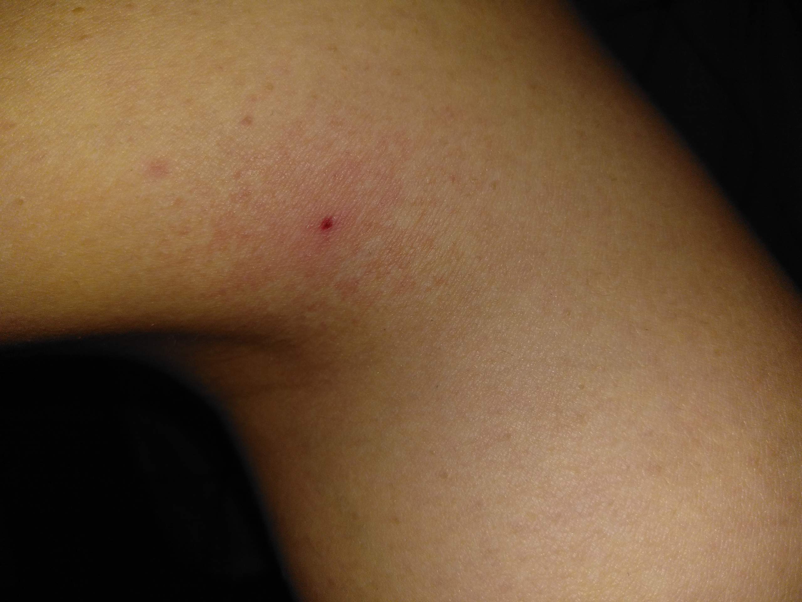 Kriebelmuckenstich Gesundheit Rot Insektenstich Kriebelmuckenstich Gesundheit Rot Insektenstich