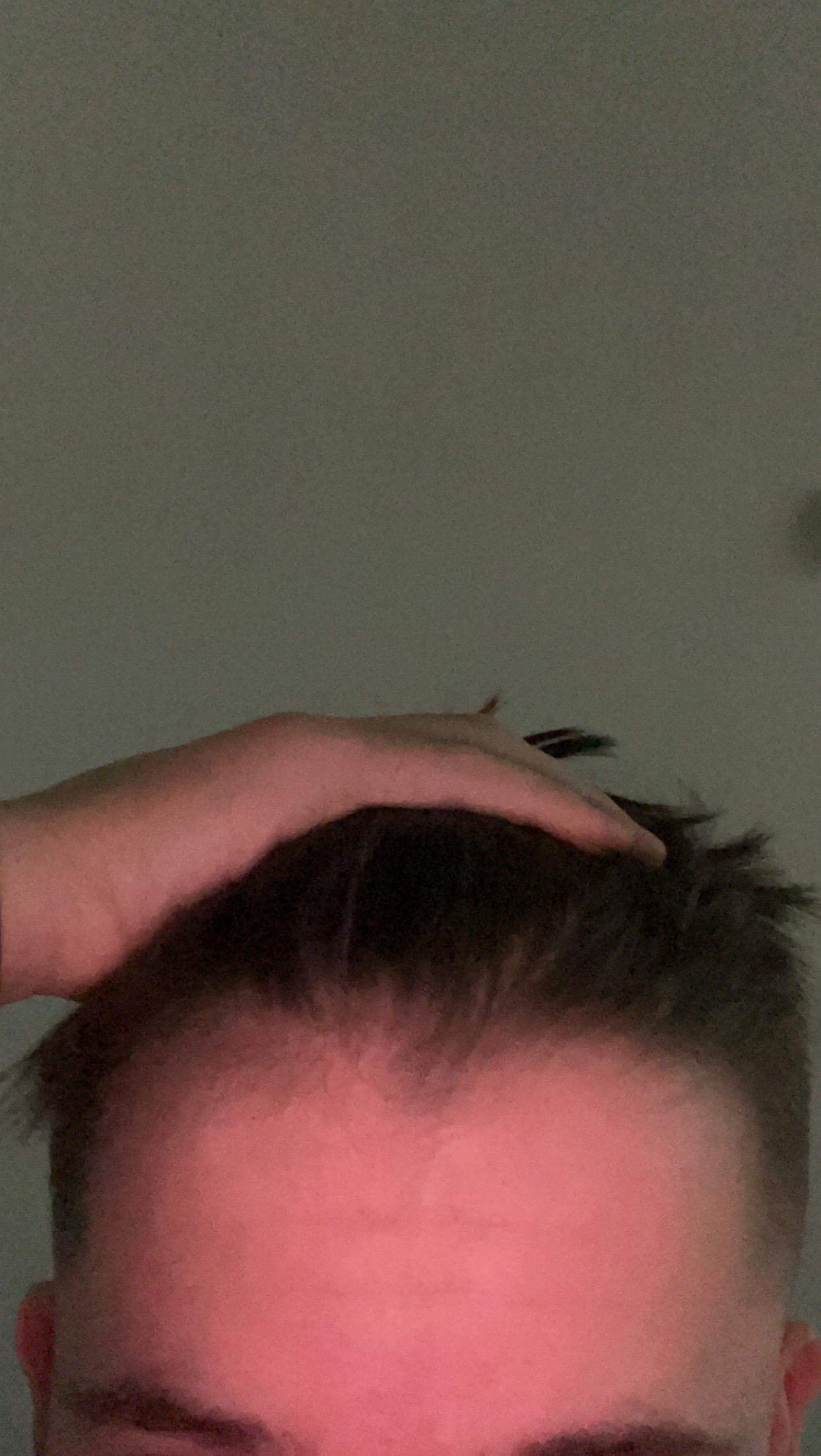 krieg ich haarausfall? (Pubertät, Friseur, Haarpflege)