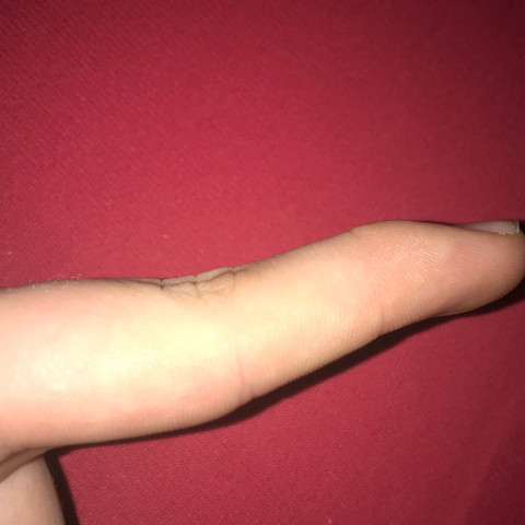 Hier ist mein finger  - (Behinderung, Finger, krumm)