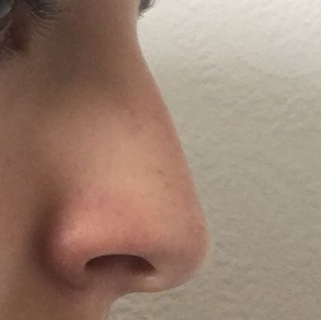 Meine Nase - (Nase, Korrektur, Nasen-OP)