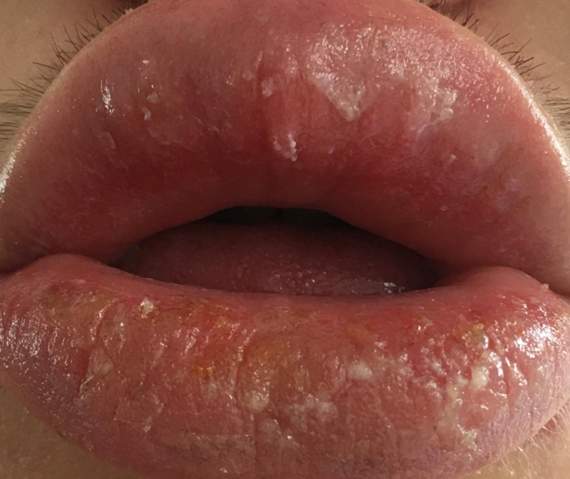 Kruste Auf Der Lippe Alles Ist Wund Gesundheit Und Medizin Wundheilung Lippenpflege Kruste Auf Der Lippe Alles Ist Wund Gesundheit Und Medizin Wundheilung Lippenpflege