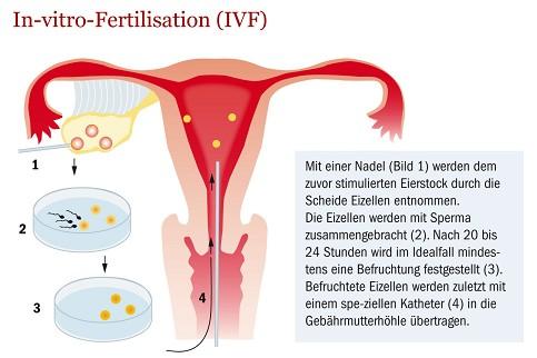 Kinderwunsch als Single k nstliche Befruchtung ohne Partner