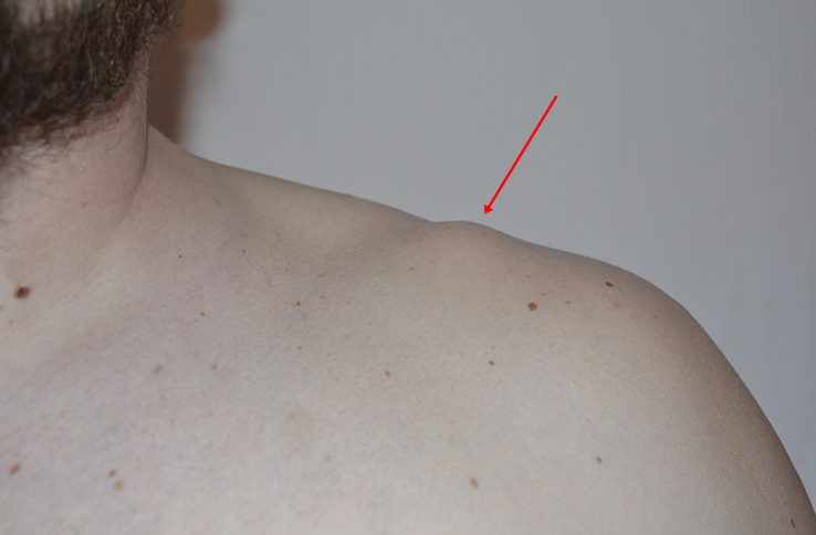 Kugel an der Schulter, Schmerzen